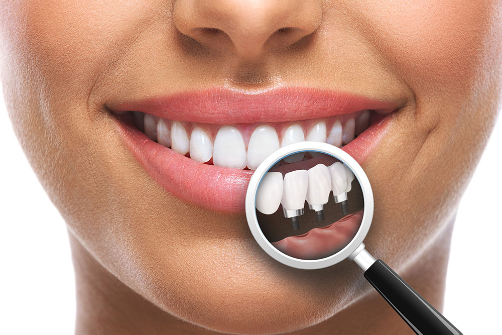 Имплантация