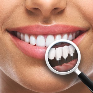 Имплантация